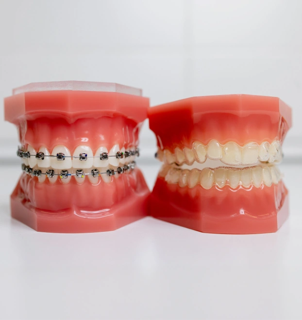 Orthodontic treatment model demonstrating teeth alignment correction