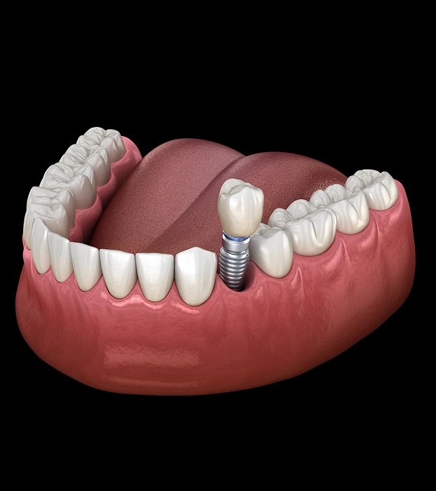 Dental implant model illustrating tooth replacement options