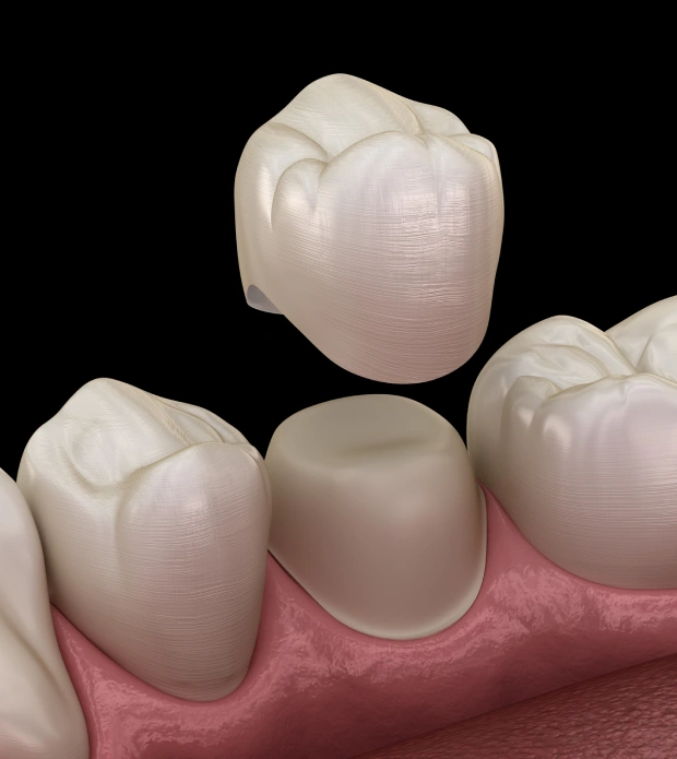 Porcelain dental crowns restoring damaged teeth