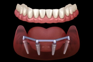 All-on-4 dental implants supporting a full arch of replacement teeth