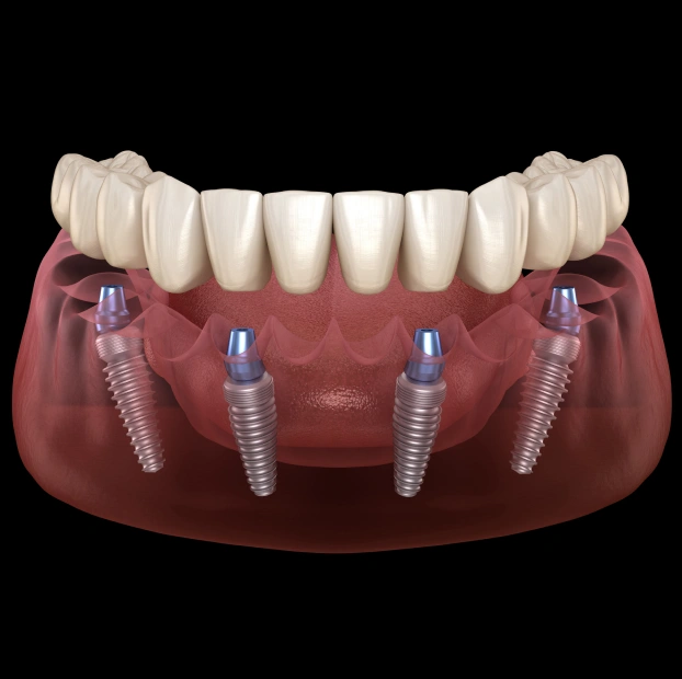 All-on-4 dental implants supporting a full arch of replacement teeth