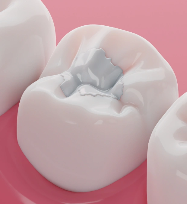 Tooth-colored composite filling used to restore a decayed or damaged tooth naturally