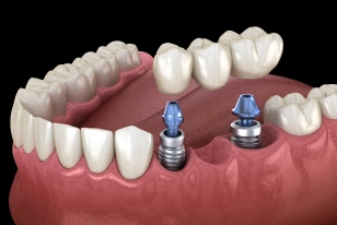 Implant-supported dental bridge replacing multiple missing teeth
