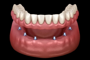 Implant-supported dentures secured with dental implants