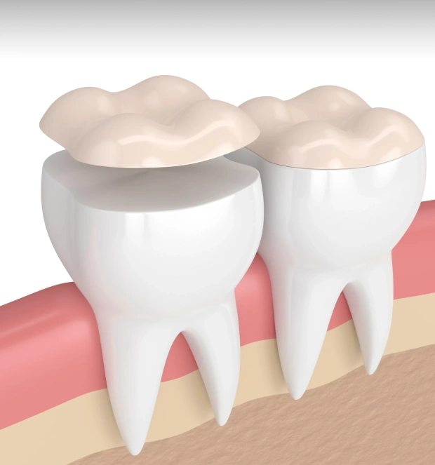 Dental onlay restoration used to repair a damaged tooth while preserving healthy tooth structure