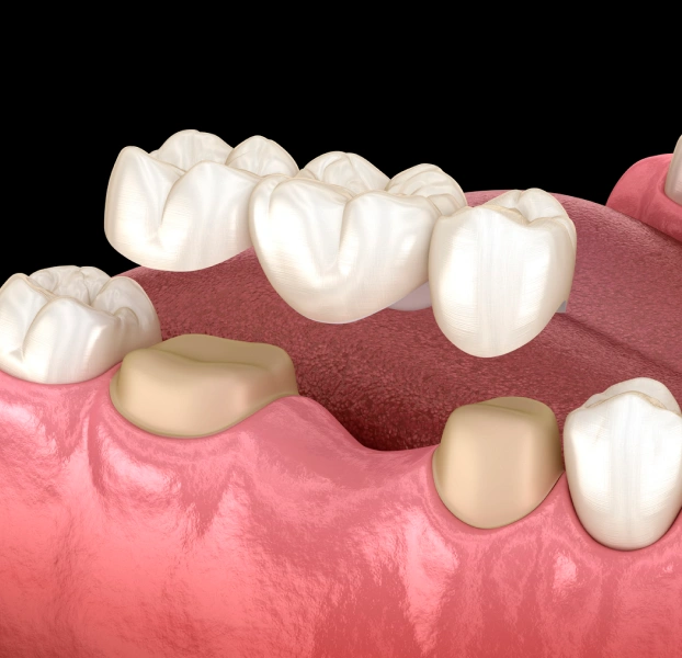 Porcelain dental bridge replacing missing teeth