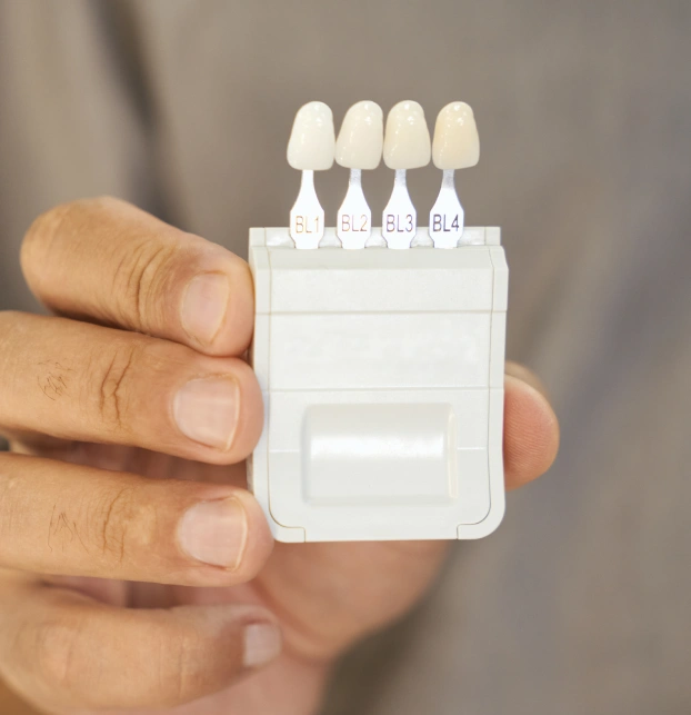 Porcelain veneers for improving smile appearance