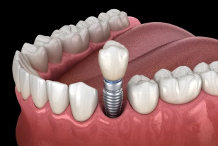 Single dental implant replacing one missing tooth naturally