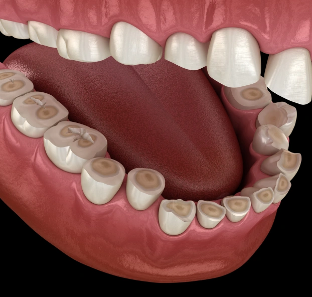 Night guard treatment for teeth grinding and bruxism