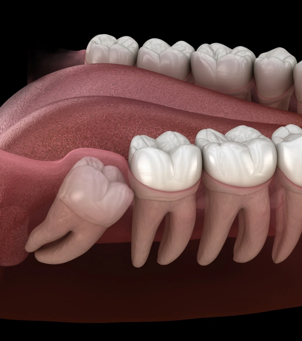 Wisdom teeth extraction illustration showing impacted molar